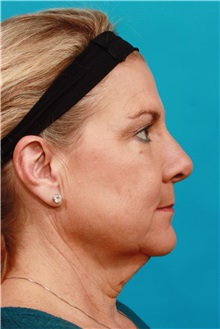 Facelift Before Photo by Michael Bogdan, MD, MBA, FACS; Grapevine, TX - Case 36902