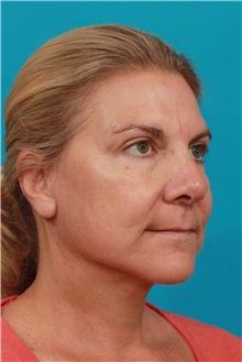 Facelift After Photo by Michael Bogdan, MD, MBA, FACS; Grapevine, TX - Case 36902