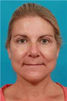 Facelift After Photo by Michael Bogdan, MD, MBA, FACS; Grapevine, TX - Case 36902