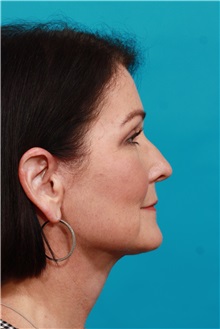 Facelift After Photo by Michael Bogdan, MD, MBA, FACS; Grapevine, TX - Case 36903