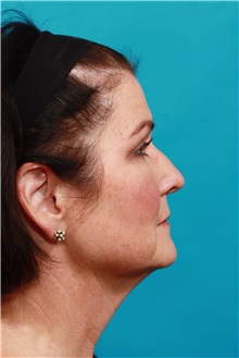 Facelift Before Photo by Michael Bogdan, MD, MBA, FACS; Grapevine, TX - Case 36903