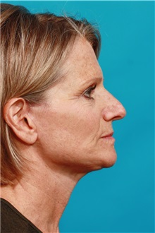 Facelift After Photo by Michael Bogdan, MD, MBA, FACS; Grapevine, TX - Case 36905