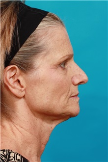 Facelift Before Photo by Michael Bogdan, MD, MBA, FACS; Grapevine, TX - Case 36905