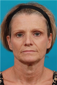 Facelift Before Photo by Michael Bogdan, MD, MBA, FACS; Grapevine, TX - Case 36905