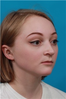 Rhinoplasty After Photo by Michael Bogdan, MD, MBA, FACS; Grapevine, TX - Case 36907