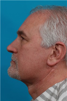 Facelift After Photo by Michael Bogdan, MD, MBA, FACS; Grapevine, TX - Case 36911