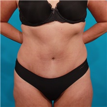 Tummy Tuck After Photo by Michael Bogdan, MD, MBA, FACS; Grapevine, TX - Case 36912