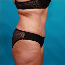 Tummy Tuck After Photo by Michael Bogdan, MD, MBA, FACS; Grapevine, TX - Case 36912