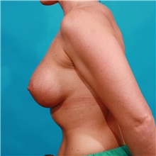Breast Augmentation After Photo by Michael Bogdan, MD, MBA, FACS; Grapevine, TX - Case 36913