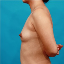 Breast Augmentation Before Photo by Michael Bogdan, MD, MBA, FACS; Grapevine, TX - Case 36973