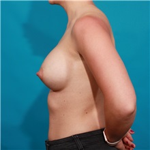 Breast Augmentation After Photo by Michael Bogdan, MD, MBA, FACS; Grapevine, TX - Case 36976