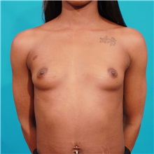 Breast Augmentation Before Photo by Michael Bogdan, MD, MBA, FACS; Grapevine, TX - Case 36977
