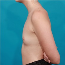 Breast Augmentation Before Photo by Michael Bogdan, MD, MBA, FACS; Grapevine, TX - Case 36978
