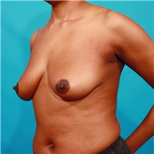 Breast Augmentation Before Photo by Michael Bogdan, MD, MBA, FACS; Grapevine, TX - Case 36979