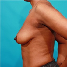 Breast Augmentation Before Photo by Michael Bogdan, MD, MBA, FACS; Grapevine, TX - Case 36979