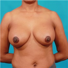 Breast Augmentation After Photo by Michael Bogdan, MD, MBA, FACS; Grapevine, TX - Case 36979