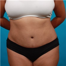 Tummy Tuck After Photo by Michael Bogdan, MD, MBA, FACS; Grapevine, TX - Case 36984