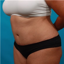 Tummy Tuck After Photo by Michael Bogdan, MD, MBA, FACS; Grapevine, TX - Case 36984