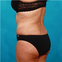 Tummy Tuck After Photo by Michael Bogdan, MD, MBA, FACS; Grapevine, TX - Case 36985
