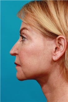 Facelift After Photo by Michael Bogdan, MD, MBA, FACS; Grapevine, TX - Case 37047