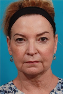Facelift Before Photo by Michael Bogdan, MD, MBA, FACS; Grapevine, TX - Case 37047
