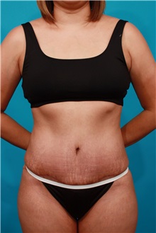 Tummy Tuck After Photo by Michael Bogdan, MD, MBA, FACS; Grapevine, TX - Case 37048