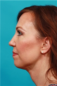 Facelift After Photo by Michael Bogdan, MD, MBA, FACS; Grapevine, TX - Case 37049