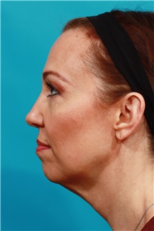 Facelift Before Photo by Michael Bogdan, MD, MBA, FACS; Grapevine, TX - Case 37049