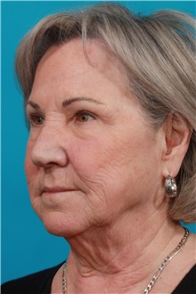 Eyelid Surgery After Photo by Michael Bogdan, MD, MBA, FACS; Grapevine, TX - Case 39187