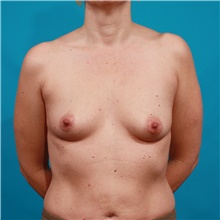 Breast Augmentation Before Photo by Michael Bogdan, MD, MBA, FACS; Grapevine, TX - Case 39190