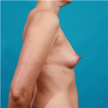 Breast Augmentation Before Photo by Michael Bogdan, MD, MBA, FACS; Grapevine, TX - Case 39190