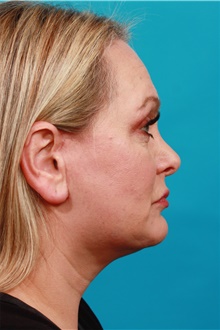 Facelift After Photo by Michael Bogdan, MD, MBA, FACS; Grapevine, TX - Case 39191