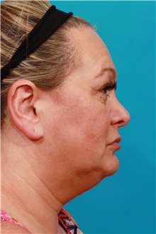 Facelift Before Photo by Michael Bogdan, MD, MBA, FACS; Grapevine, TX - Case 39191