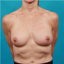 Breast Implant Revision After Photo by Michael Bogdan, MD, MBA, FACS; Grapevine, TX - Case 39193