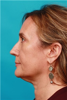 Eyelid Surgery After Photo by Michael Bogdan, MD, MBA, FACS; Grapevine, TX - Case 39198