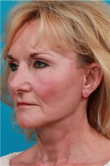 Facelift After Photo by Michael Bogdan, MD, MBA, FACS; Grapevine, TX - Case 39199