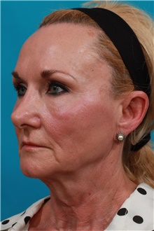 Facelift Before Photo by Michael Bogdan, MD, MBA, FACS; Grapevine, TX - Case 39199