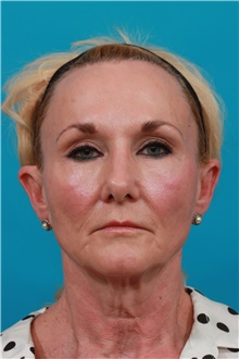 Facelift Before Photo by Michael Bogdan, MD, MBA, FACS; Grapevine, TX - Case 39199