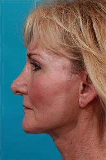 Facelift After Photo by Michael Bogdan, MD, MBA, FACS; Grapevine, TX - Case 39199