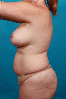 Tummy Tuck Before Photo by Michael Bogdan, MD, MBA, FACS; Grapevine, TX - Case 39202