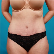 Tummy Tuck After Photo by Michael Bogdan, MD, MBA, FACS; Grapevine, TX - Case 39207