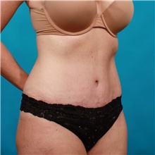 Tummy Tuck After Photo by Michael Bogdan, MD, MBA, FACS; Grapevine, TX - Case 39207
