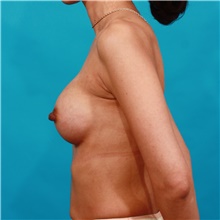 Breast Augmentation After Photo by Michael Bogdan, MD, MBA, FACS; Grapevine, TX - Case 39209