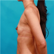 Breast Augmentation Before Photo by Michael Bogdan, MD, MBA, FACS; Grapevine, TX - Case 39209