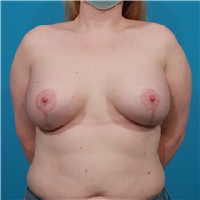 Breast Augmentation After Photo by Michael Bogdan, MD, MBA, FACS; Grapevine, TX - Case 44353