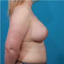 Breast Augmentation After Photo by Michael Bogdan, MD, MBA, FACS; Grapevine, TX - Case 44353