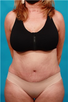 Body Contouring After Photo by Michael Bogdan, MD, MBA, FACS; Grapevine, TX - Case 44356