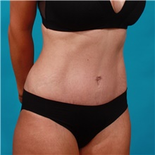 Tummy Tuck After Photo by Michael Bogdan, MD, MBA, FACS; Grapevine, TX - Case 44357