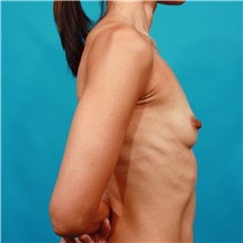 Breast Augmentation Before Photo by Michael Bogdan, MD, MBA, FACS; Grapevine, TX - Case 44361
