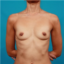 Breast Augmentation Before Photo by Michael Bogdan, MD, MBA, FACS; Grapevine, TX - Case 44361